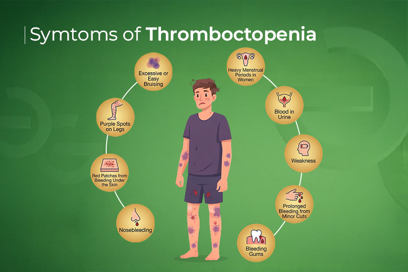 Symptoms of 
Thrombocytopenia