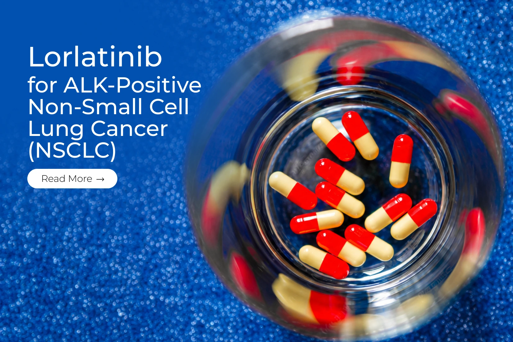 Lorlatinib for ALK-Positive Non-Small Cell Lung Cancer (NSCLC)